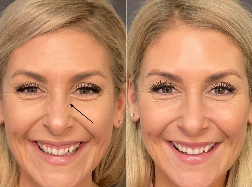 Illustrative before-and-after comparison showing bunny lines beside the nose softened