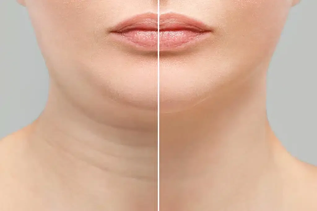 Illustrative before-and-after comparison showing the chin and under-chin profile