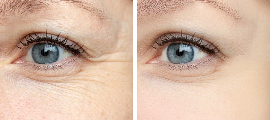 Illustrative before-and-after comparison showing crow’s feet at the outer corner of the eye softened