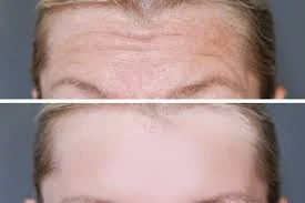 Illustrative before-and-after comparison showing horizontal forehead lines softened