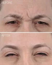 Illustrative before-and-after comparison showing vertical frown lines between the brows softened