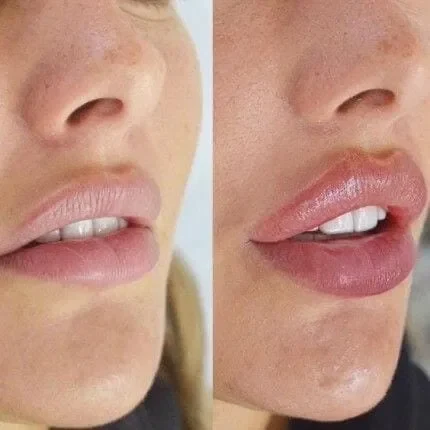 Illustrative before-and-after comparison showing added lip volume and definition
