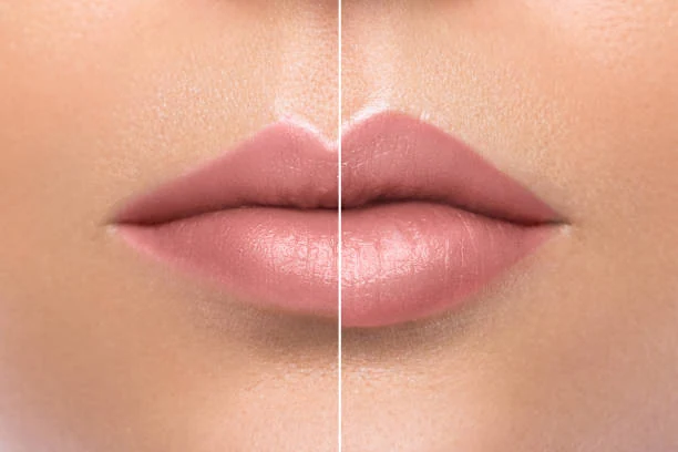 Illustrative before-and-after comparison showing upper lip shape and definition