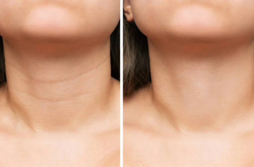 Illustrative before-and-after comparison showing neck bands and jawline definition